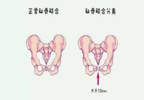 耻骨联合分离1