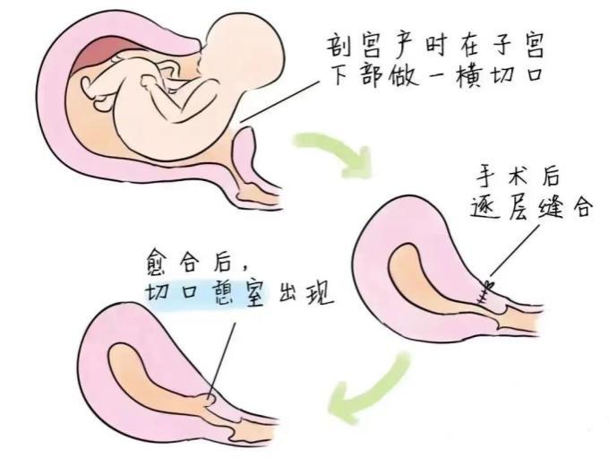 C:\Users\75590\Desktop\子宫瘢痕憩室.jpg