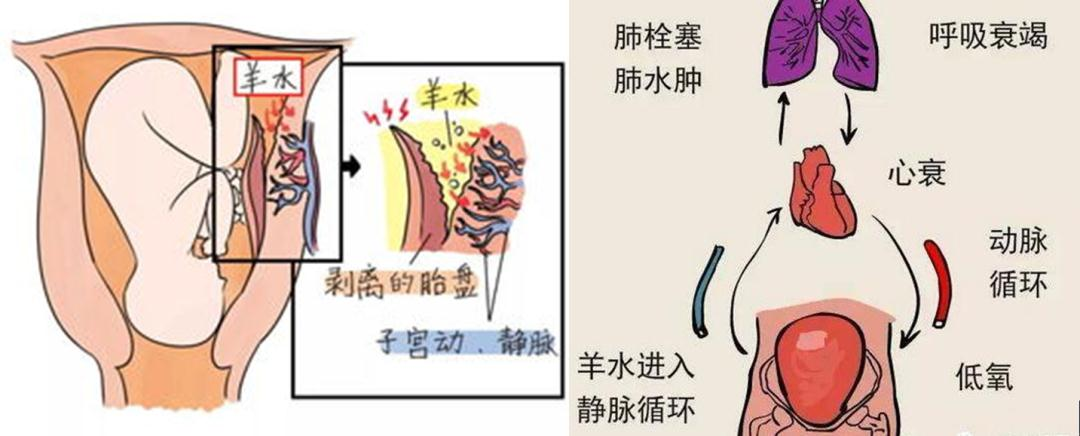羊水栓塞