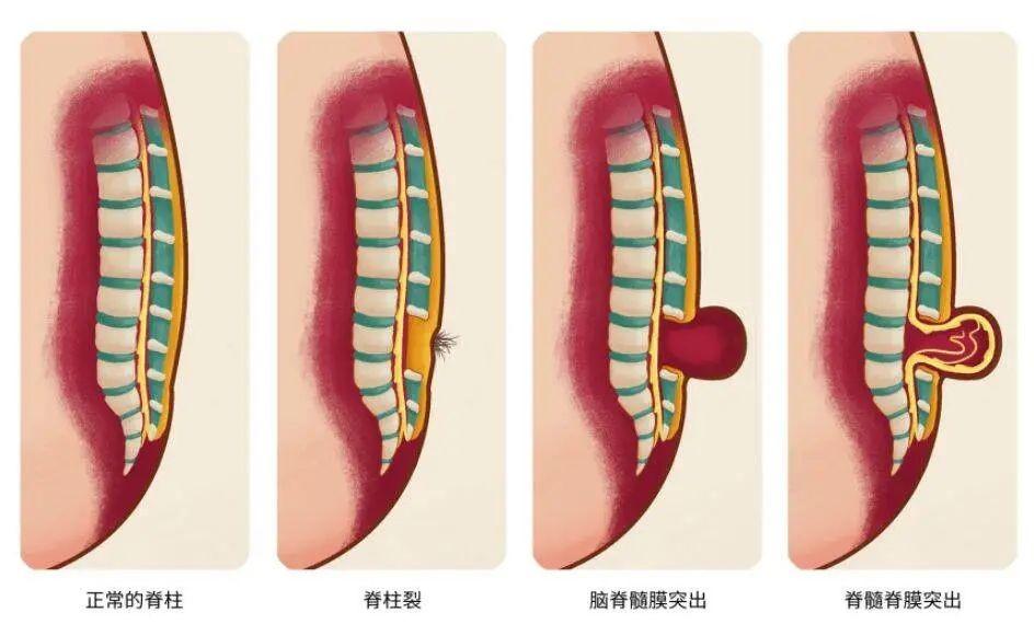 脊柱裂